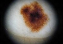 Δερματοσκόπηση