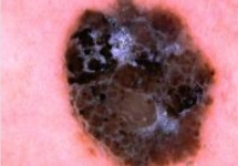 Δερματοσκόπηση