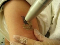 Laser αφαίρεσης tatoo (τατουάζ)